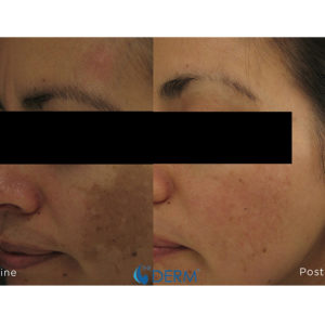 AGE-MANAGEMENT-LASER-TREATMENTS-1-web-Revision AGE-MANAGEMENT-LASER-TREATMENTS-1-web-Revision