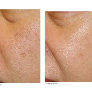 Before-and-After-IPLphotfacial-web Before-and-After-IPLphotfacial-web