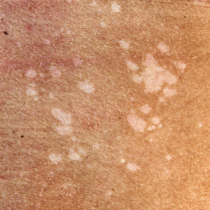 Fungal-Infections