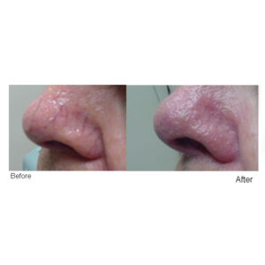 Nose-B-&-After-square Nose-B-&-After-square