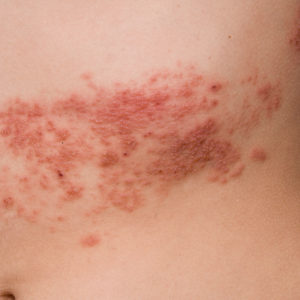 Shingles-2