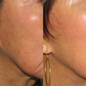 dermaplaningBnA