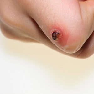 warts