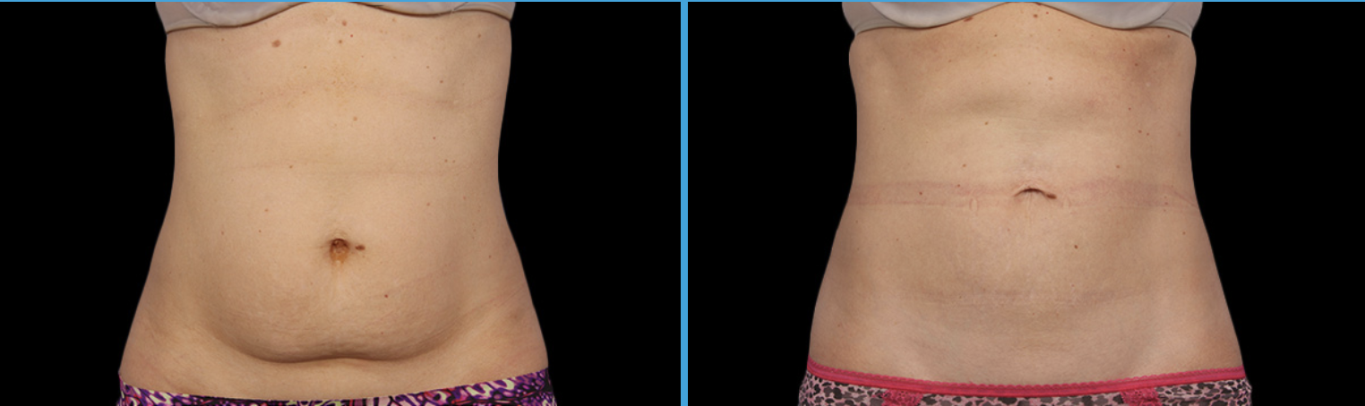 coolsculpting fat freeze