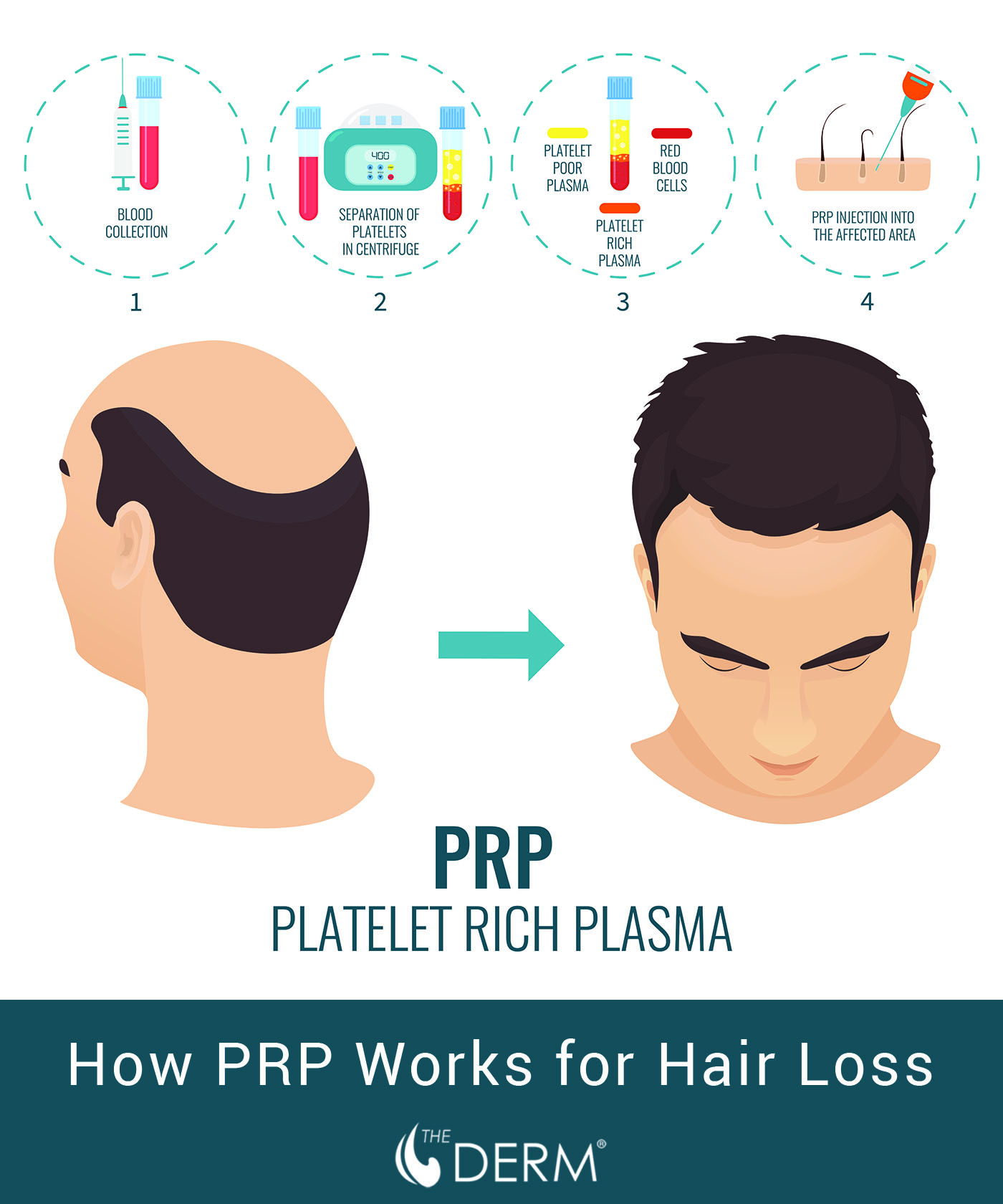 prp for hair loss