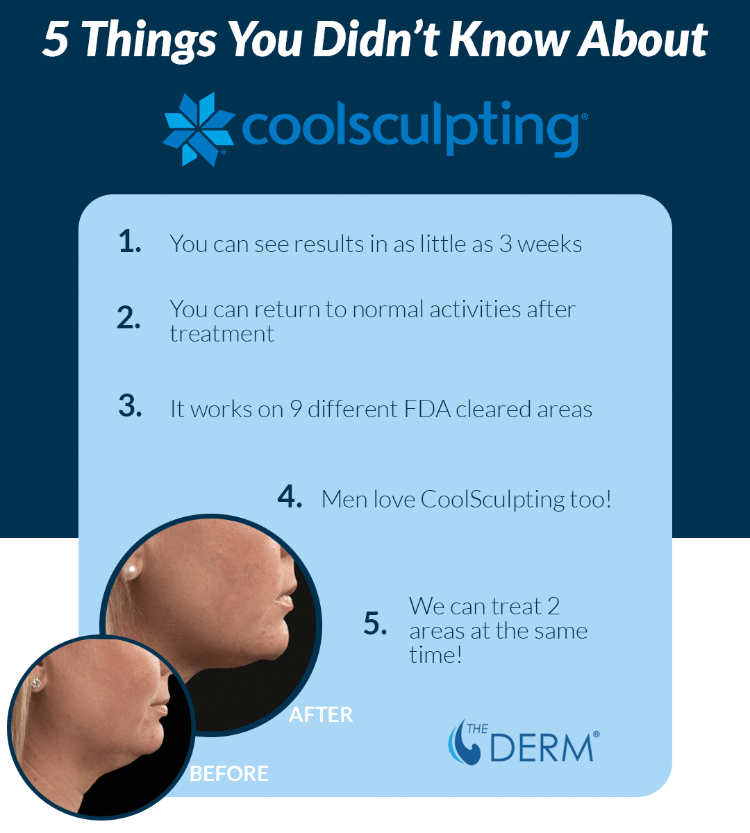 things you didn't know about coolsculpting