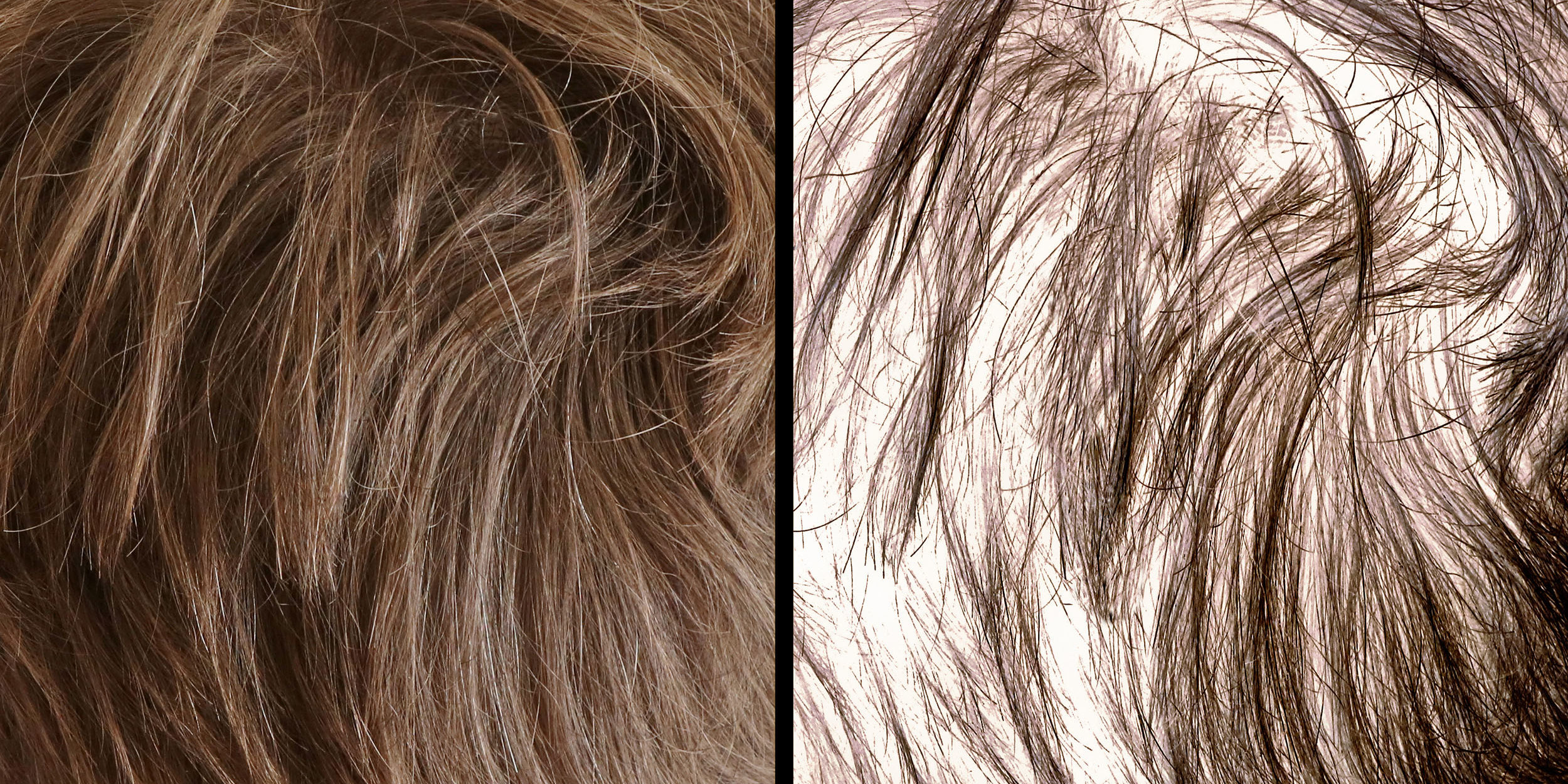 Hair loss