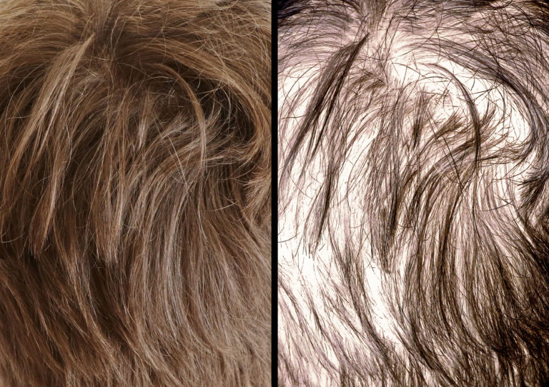 Hair loss Hair loss