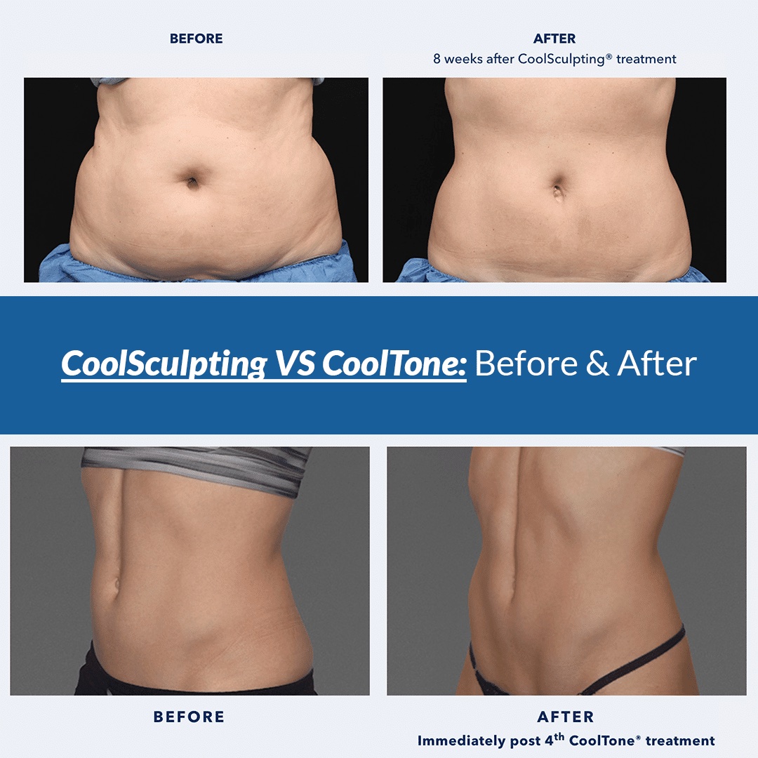 coolsculpting vs cooltone before and after coolsculpting vs cooltone before and after