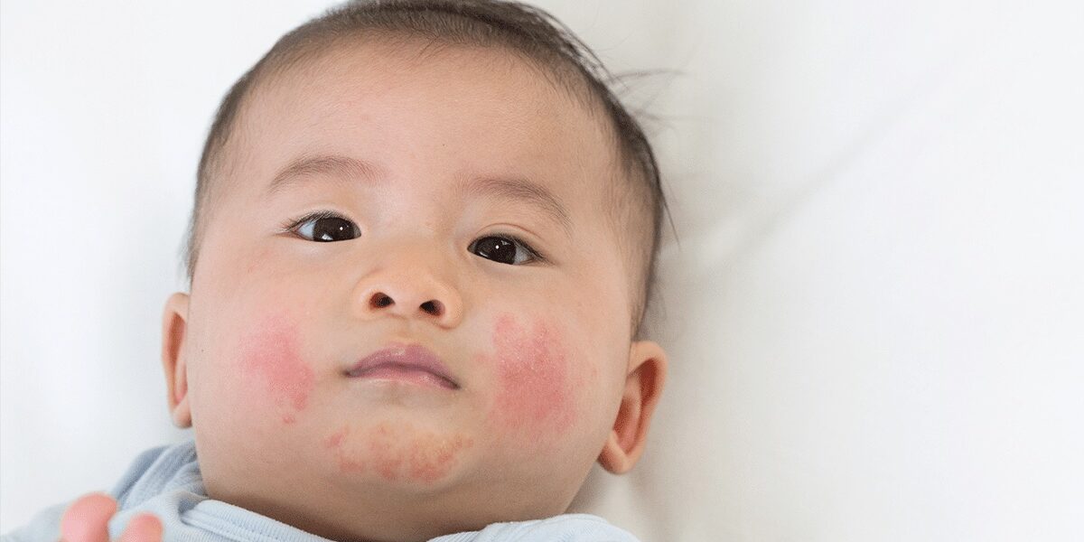 eczema in kids eczema in kids