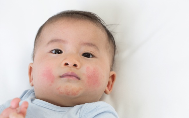 eczema in kids eczema in kids