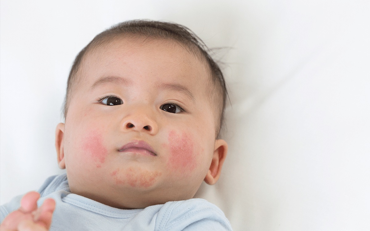 eczema in kids eczema in kids