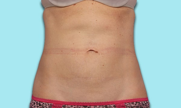 Abdomen-After