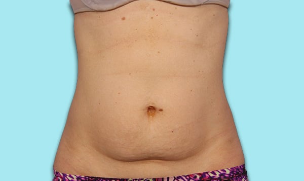 Abdomen-Before