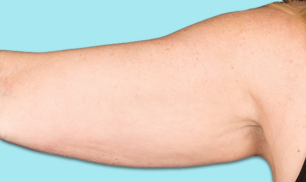 Arm-After