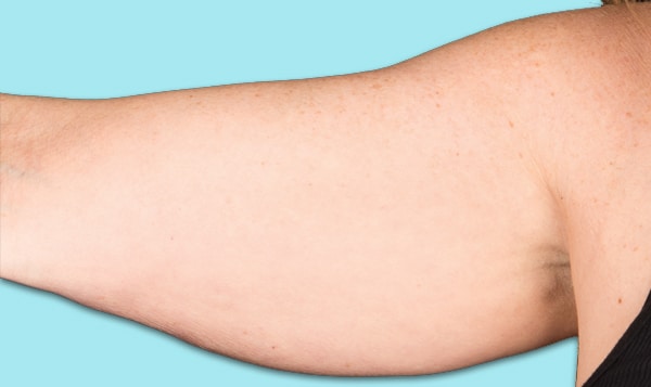 Arm-Before