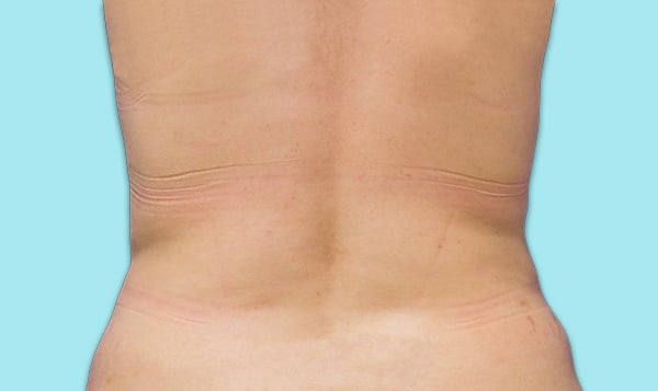 Back-After