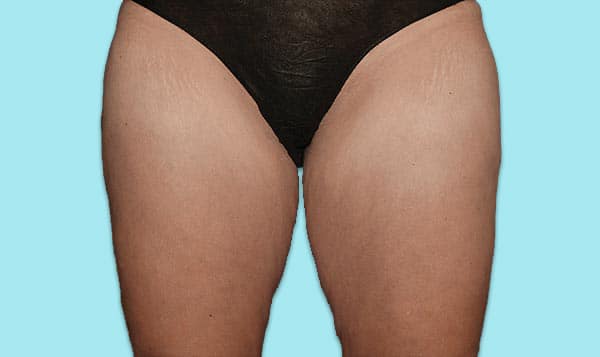 Thighs-After