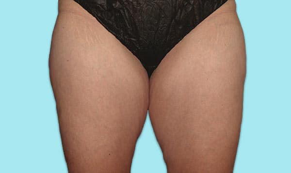 Thighs-Before