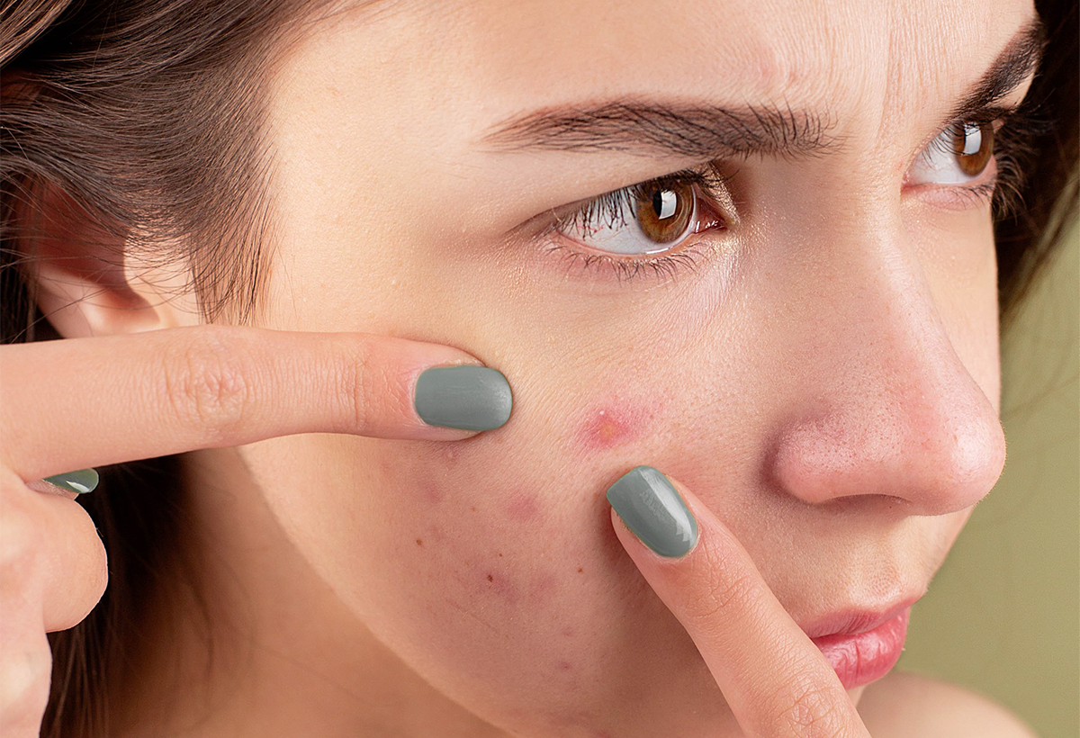 all about acne all about acne