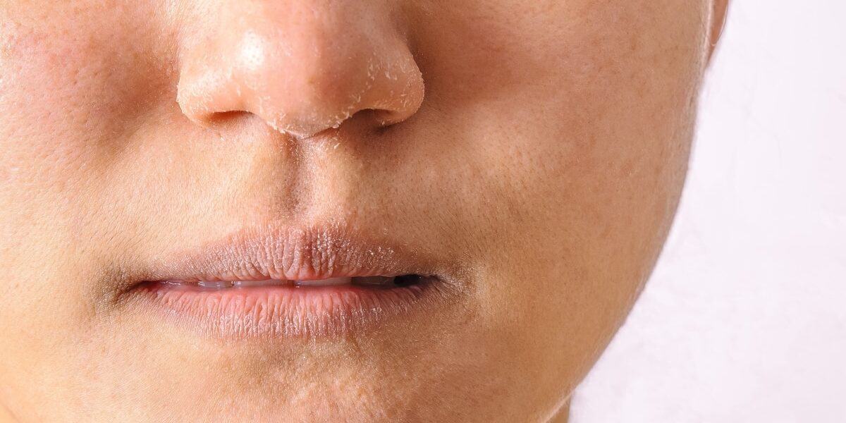 Allergic women have eczema dry nose and lips on winter season closeup.
