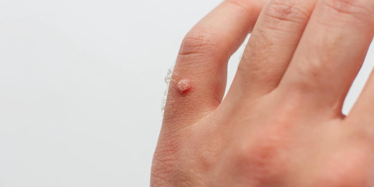 wart on hand finger isolated on white background wart on hand, skin problem