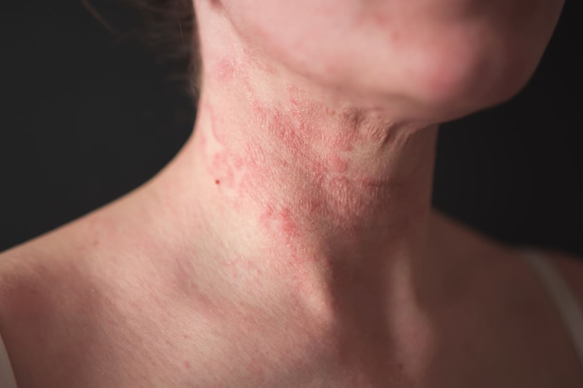 the girl has dermatitis on the neck on a black background