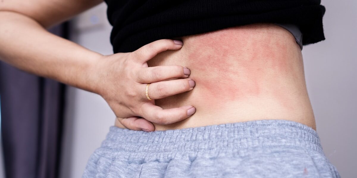 Woman scratching itchy skin rash on her back due to allergy