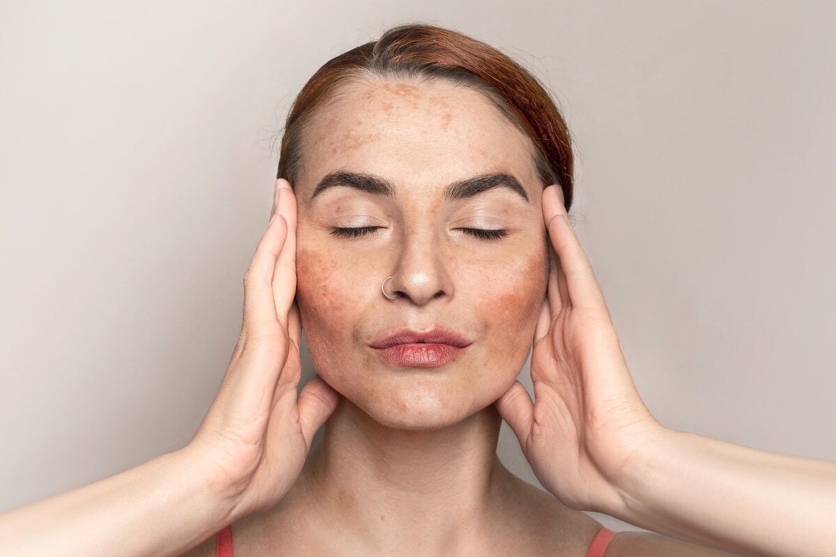 the-derm_blog_alcohol-and-melasma