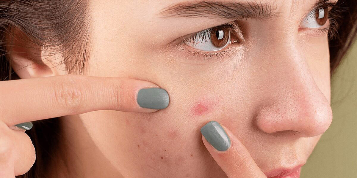 all-about-acne all about acne